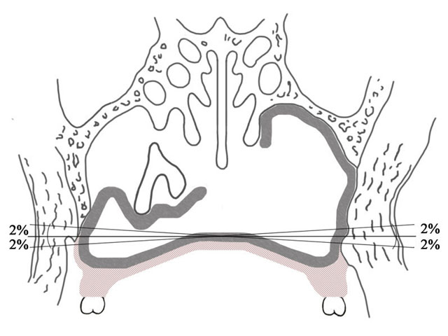 Мал. 1. Програмовано-можливе амортизаційне зміщення обтуральної частини протеза праворуч і ліворуч