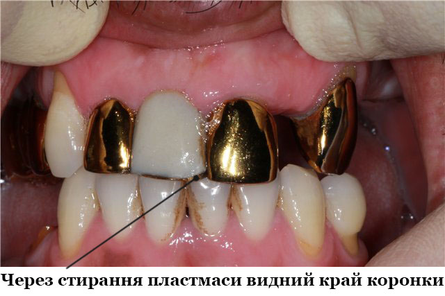 Plastmassovye-koronki_2т