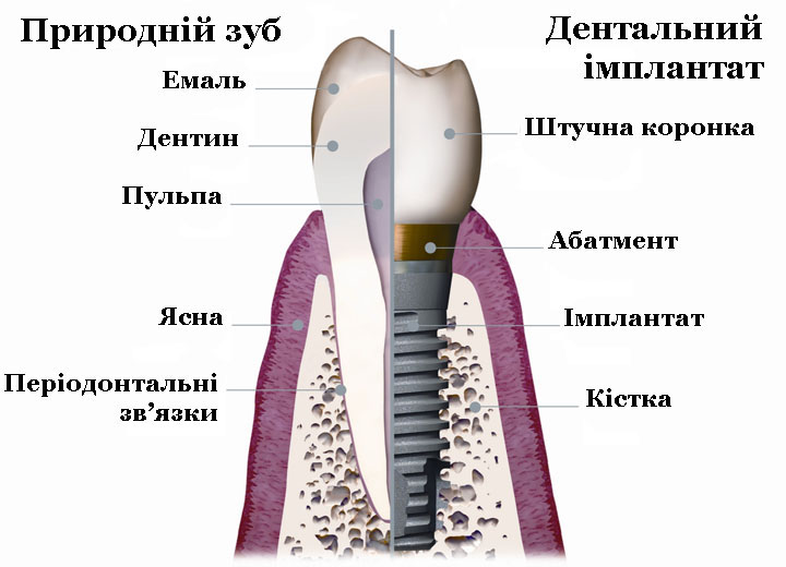 Імплантація_14