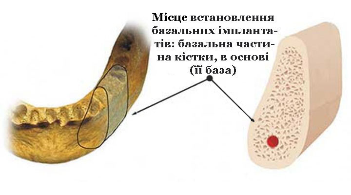 Імплантація_8